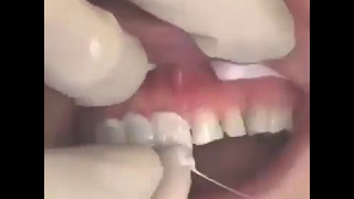 Închiderea diastemei prin faţete ceramiceDiastema closure with ceramic veneers [upl. by Hna]