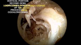 FACIAL NERVE DECOMPRESSION ENDOSCOPIC VIEW [upl. by Areemas518]