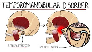 Temporomandibular Joint Disorder Explained TMJ Dysfunction  Includes Treatment amp Anatomy [upl. by Mcnutt]