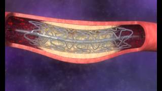 medical animation  stent opening blood flow [upl. by Gagnon]