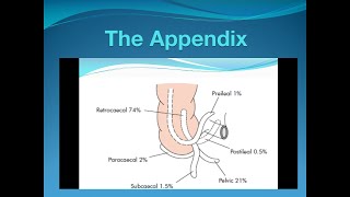 Acute Appendicitis [upl. by Oza]