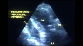 Pericardial effusion or hemopericardium to drahmadmirdamadisi4YcoVxIYKdkLrw2q [upl. by Whitson]