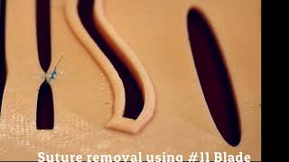 Suture Removal Using 11 scalpel [upl. by Akinna962]