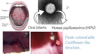 Oral Papilloma  Symptoms causes treatment [upl. by Aubreir]