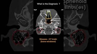 Sinuses  CT brain  bone windows CT Brain Anatomy Sinuses Quiz 6radiologychannel007 [upl. by Dever]