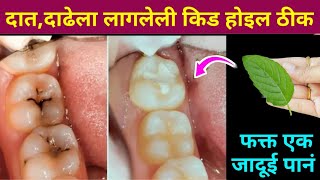 घरातील फक्त 2 वस्तू वापरा दातांन संबंधित सर्व समस्या दूर होतील😱 kitchen tips  teeth  home remedies [upl. by Akkire]