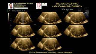 Arthrogryposis congenita 23 weeks [upl. by Toney]