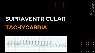 Supraventricular Tachycardia  SVT [upl. by Dielle]