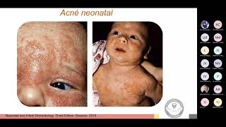 Dermatologia Pediatrica para Pediatras [upl. by Trilbee]