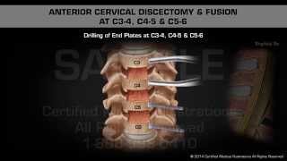 Anterior Cervical Discectomy amp Fusion at C34 C45 amp C56 [upl. by Hasheem]