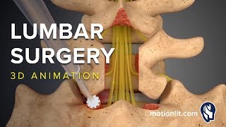 Lumbar Surgery  Laminectomy  3D Medical Animation [upl. by Maurise]