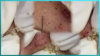 Big Cystic Acne Blackheads Extraction Blackheads amp Milia Whiteheads Removal Pimple Popping [upl. by Erotavlas]