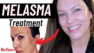 MELASMA TREATMENT at HOME FADE DARK SPOTS HYPERPIGMENTATION MELASMA [upl. by Natsirc217]