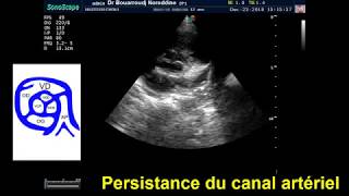 Persistance du canal artérieléchocardiographie [upl. by Bentley]