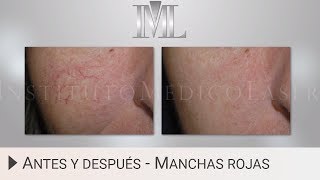 PUNTOS RUBÍ NEVUS RUBÍ 🔴 ¿Cómo ELIMINAR RÁPIDAMENTE 💋 Eterna Juventud Medical Estetic Center [upl. by Reve959]