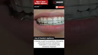 Upper amp Lower Hawleys Retainer  Hawleys Appliance Orthodontics 💯 shorts dentist viral 🔥 [upl. by Yhtomot]