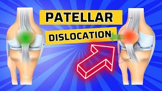 Top 3 Exercises after Patellar Dislocation How to Strengthen the VMO [upl. by Sieber]