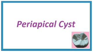 Periapical Cyst or Radicular Cyst  Important Notes  Cysts of Orofacial region 2  Oral Pathology [upl. by Ainel674]