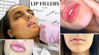 GETTING LIP FILLERS FOR THE FIRST TIME  1ml Before and After VLOG [upl. by Niemad725]