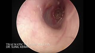 Traumatic Tympanic Membrane Perforation [upl. by Asiulairam]