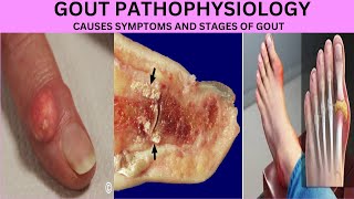 PATHOPHYSIOLOGY OF GOUTHYPERURECEMIAMONOSODIUM URATE CRYSTALSSTAGES OF GOUTSYMPTOMS OF GOUT [upl. by Akiam]