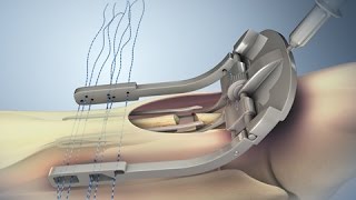 Achilles Tendon Rupture and Repair [upl. by Tolland]