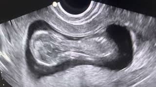 Utrasound of 12 Week Pregnancy [upl. by Cormick936]