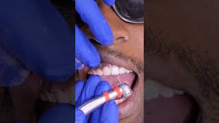 How Tooth Shaving Works [upl. by Hathaway]