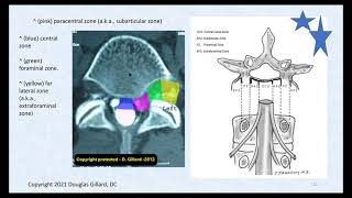 3 Key Ligaments of the Lumbar Spine and Their Related Pathology Disc Herniation Stenosis amp DISH [upl. by Nannahs587]