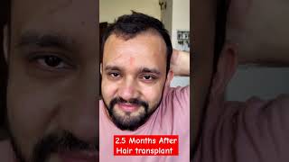 25 Months HAIR TRANSPLANT Update besthairtransplant qhthairtransplant [upl. by Nabala]