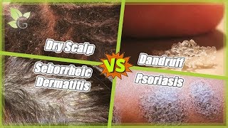 Dry Scalp vs Dandruff vs Seborrheic Dermatitis vs Psoriasis [upl. by Cruz]