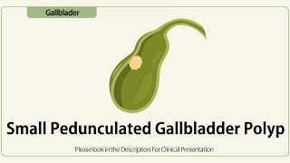 Small Pedunculated Gallbladder Polyp [upl. by Adnolahs]