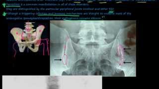 96P Introduction to the Seronegative Spondyloarthropathies [upl. by Atteras]