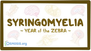 Syringomyelia Year of the Zebra [upl. by Noteloc]