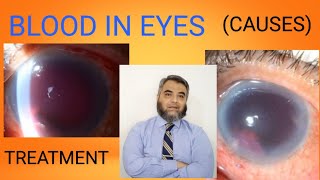 HYPHEMABLOOD ACCUMULATION IN EYES [upl. by Maon]