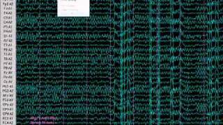 ELECTROENCEFALOGRAMA DE 32 CANALES INTERFAZ A PC EEG KT883200 [upl. by Aehtla267]