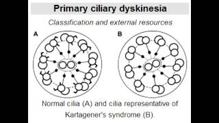 Kartageners Syndrome dynein arm defect affecting cilia [upl. by Iddet]