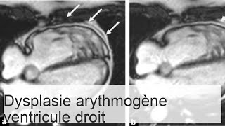 Dysplasie arythmogène du ventricule droit  causes symptômes et méthodes de traitement [upl. by Nettie]