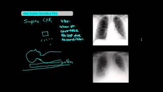 Types of Chest XRays part 2  Lateral Supine Decubitus UndergroundMed [upl. by Lusty829]