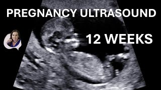 12 weeks pregnancy ultrasound video [upl. by Ecidnac]