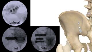 Corelink Entasis Sacroiliac Joint Fusion [upl. by Euqitsym]