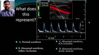 Secrets of Carotid Ultrasound [upl. by Jamison]