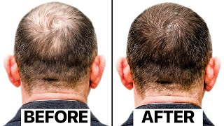 The Truth Behind This New Hair Loss Treatment  Exosomes [upl. by Devon944]