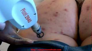 Embarrassing Bodies  Acne  Pixel laser resurfacing [upl. by Nref]