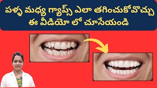 పళ్ళ మధ్య గప్స్ ని ఎలా సరిచేస్తారో చూసేయండి  Clips treatment [upl. by Cletus599]