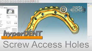 hyperDENT Tutorial Angulated Screw Channels [upl. by Clarie]