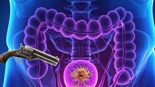 Episode 86 Dual Treatment For Bladder Cancer with Gemcitabine and Docetaxel Bladder Instillations [upl. by Cosmo]