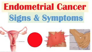 Endometrial Cancer Signs amp Symptoms amp Why They Occur [upl. by Inalawi]