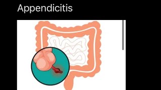 Apendicitis nursing care [upl. by Neenad939]