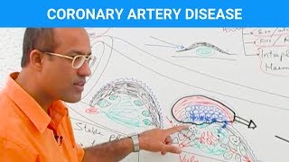 Coronary Artery Disease  Ischemic Heart Disease  Angina🫀 [upl. by Retswerb965]